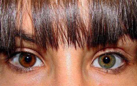 Olhos Cores Diferentes Entenda O Que Pode Ser Viva Oftalmologia