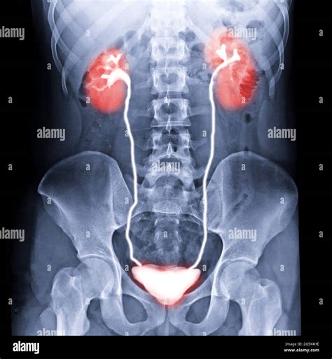 Intravenous Pyelogram Or I V P Is An X Ray Exam Of Urinary Tract After