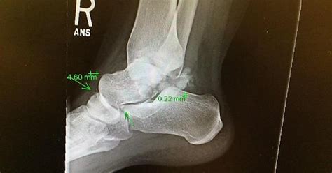 Talus Fracture X Rays And Photograph Tw Broken Bone Album On Imgur