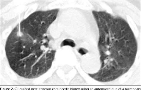 Figure 1 From Percutaneous Core Needle Biopsy For Small ≤ 10 Mm Lung