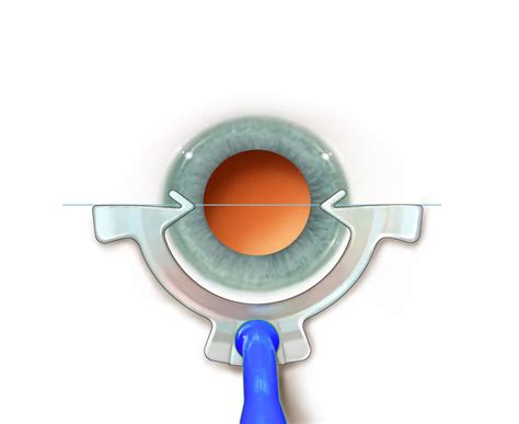 Scleral IOL Fixation Solutions Pack MicroSurgical Technology