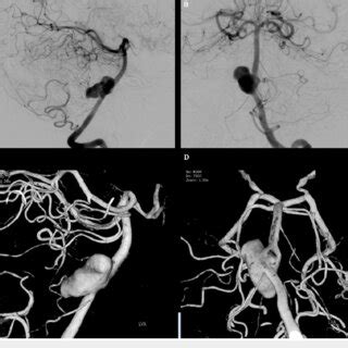 Left Vertebral Artery Angiography With 3D RA A B Lateral And