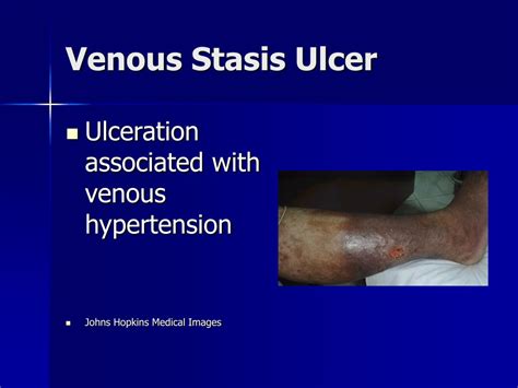 Venous Stasis Ulcer Stages