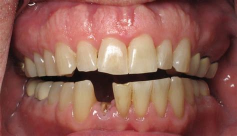 Lower Front Tooth Implants