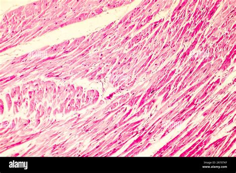 Heart Hypertrophy Photomicrograph Showing Hypertrophic Myocardium With