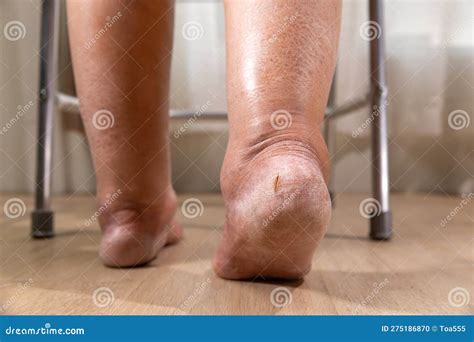 Edema Is Swelling Caused By Excess Fluid Trapped In Your Body S Tissues