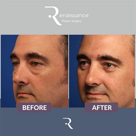 Male Eyelid Surgery Before And After Renaissance Plastic Surgery