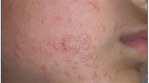 Understanding Molluscum Contagiosum Symptoms Causes And Treatments