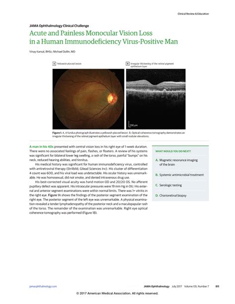 Acute And Painless Monocular Vision Loss In A Human Immunodeficiency