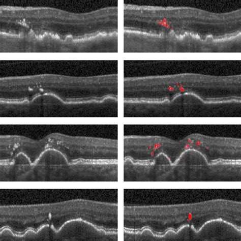 The left figure shows SD-OCT image of an eye with drusen. The drusen... | Download Scientific ...