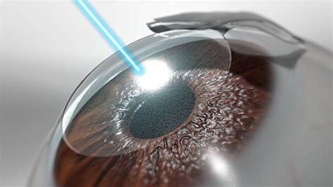 Repeat Lasik Surgery After 10 Years