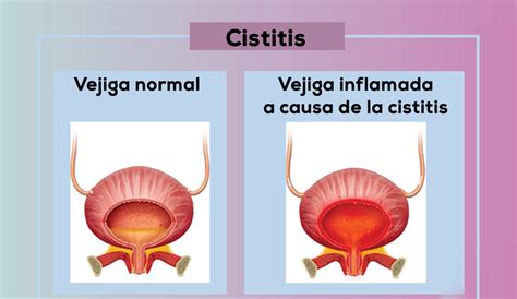 Consultorio Abierto Cu L Es La Diferencia Entre Cistitis E Infecci N