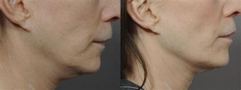 Ultherapy® Before And After Photo Gallery Rochester Ny Q The