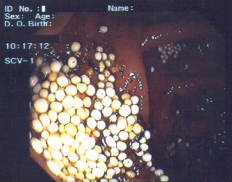 Endoscopic View Of The Colon Intraluminal Presence Of Numerous Spherical White “eggs” Of About