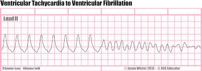 ECG Educator Blog : Six Second ECG Rhythm Strips