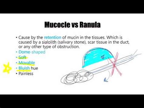 Ranula Histology