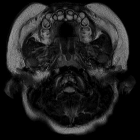 Achondroplasia Wikidoc