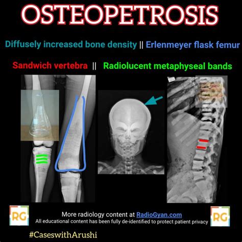 OSTEOPETROSIS | Radiology, Diagnostic imaging, Radiology student