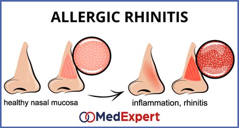 Allergic Rhinitis Symptoms And Nose Allergy Treatment MED Expert