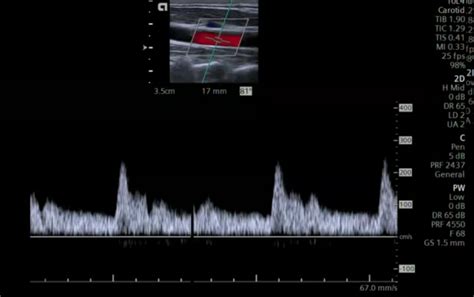 5 Color Doppler Imaging Of The Carotid Arteries 123sonography