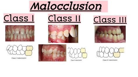 Malocclusionsclass Iclass Iiclass Iiiclinical Featuresquick Revision Youtube