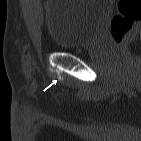 The Role Of Pubic Symphyseal CT Arthrography In The Imaging Of Athletic