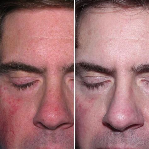 Rosacea Treatment Before And After Kingsway Dermatology