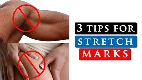 How To Get Rid Of Stretch Marks On Your Shoulders Legs Stomach Youtube