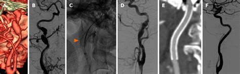 Figure From Treatment Of Extracranial Internal Carotid Artery