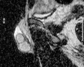 Sagittal T Weighted Turbo Spin Echo Mri Showing Two Testes Within The