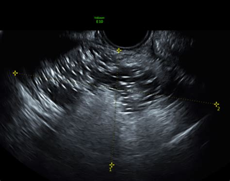 Dermoid Cyst Melaka Fertility