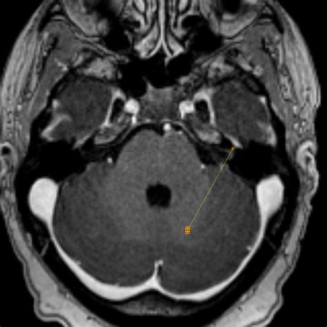 Ramsay Hunt Syndrome Mri