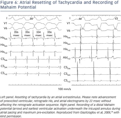 Figure 6 Atrial Resetting Of Tachycardia And Recording Of Mahaim Potential Radcliffe Cardiology