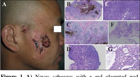 Figure 1 From Unusual Cutaneous Manifestations Of Late Lyme Borreliosis