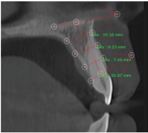 Sagittal View Of Right Maxillary Central Incisor With Measurement Of Download Scientific