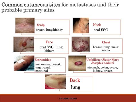 Cutaneous Manifestations Of Internal Malignancy And Paraneoplastic Sy