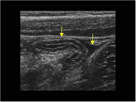 Pediatrics | 9.1 Pediatric abdomen and retroperitoneum : Case 9.1.7 ...