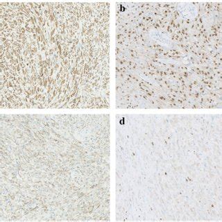 Tumor Cells Showed Diffuse Staining Of AE1 AE3 A And ERG B With