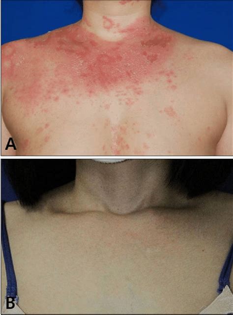 Pustular Psoriasis In Case 1 A Marked Improvement Was Observed After