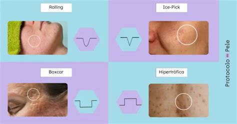 Tratamentos De Cicatriz De Acne Funciona Quais Existem Protocolo