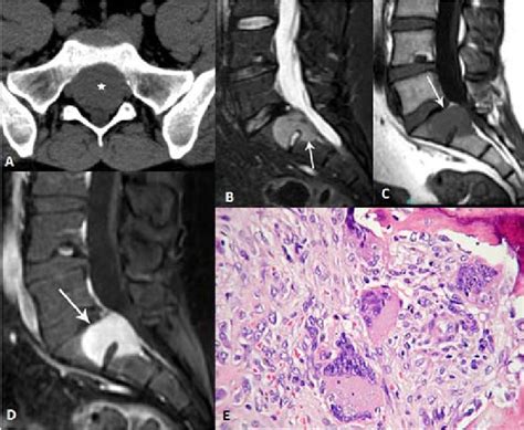 Figure 1 from Rare Solitary Primary Osseous Lesions of the Spine in ...