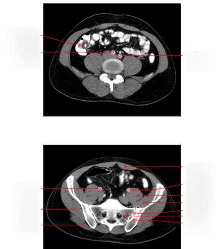 Diagram Radiologie Anatomie Abdomen 5 Quizlet