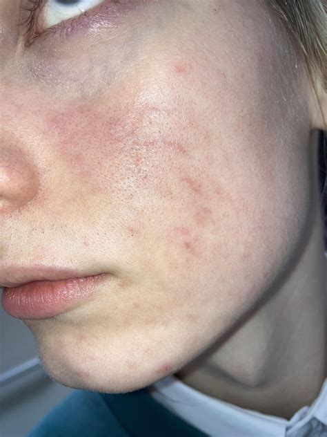 face red blotches 4