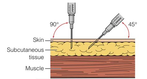 ADMINISTERING A SUBCUTANEOUS INJECTION Flashcards Quizlet