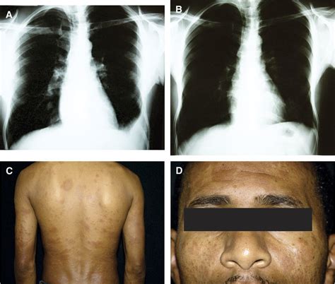 Tuberculosis Patient Before And After