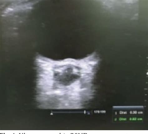 Figure 1 From Evaluation Of Ultrasonographic Optic Nerve Sheath Diameter And Central Retinal