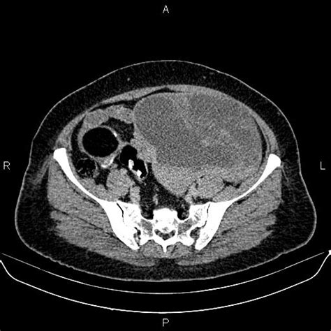 Ovarian Serous Cystadenocarcinoma Image