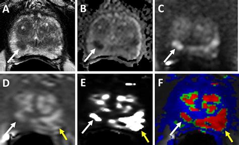 Dce Mri Of Prostate Cancer Springerlink