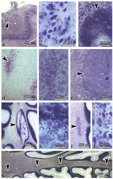 Topography And Morphology Of Heterotopias In The Brains Of Individuals