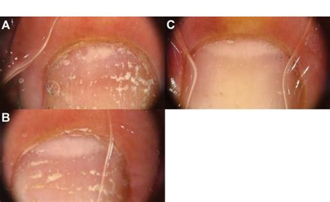 432 Calcipotriene 0005betamethasone Dipropionate 0064 Foam As A Treatment For Nail